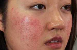 Mẹo hay dùng Thuốc Bắc Tái Tạo Da trị sạch mụn