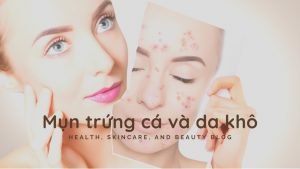 Làm gì khi bị mụn trứng cá trên làn da khô