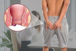 TOP 10 bài thuốc nam chữa bệnh trĩ hiệu quả nhất