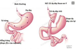 Những điều cần biết về phẫu thuật giảm cân