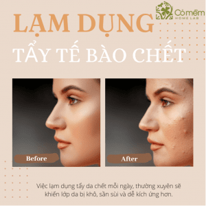 5 nguyên nhân gây mụn và 7+ Tips ngăn ngừa mụn cực hiệu quả