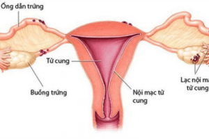 U nang buồng trứng và lạc nội mạc tử cung: Mối liên hệ chặt chẽ